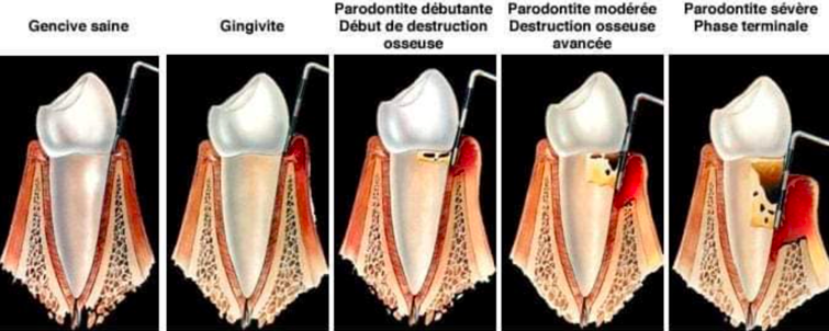 Etapes parodontite