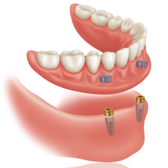 pacsi dents